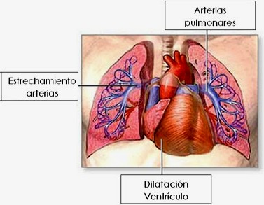 hipertension_pulmonar
